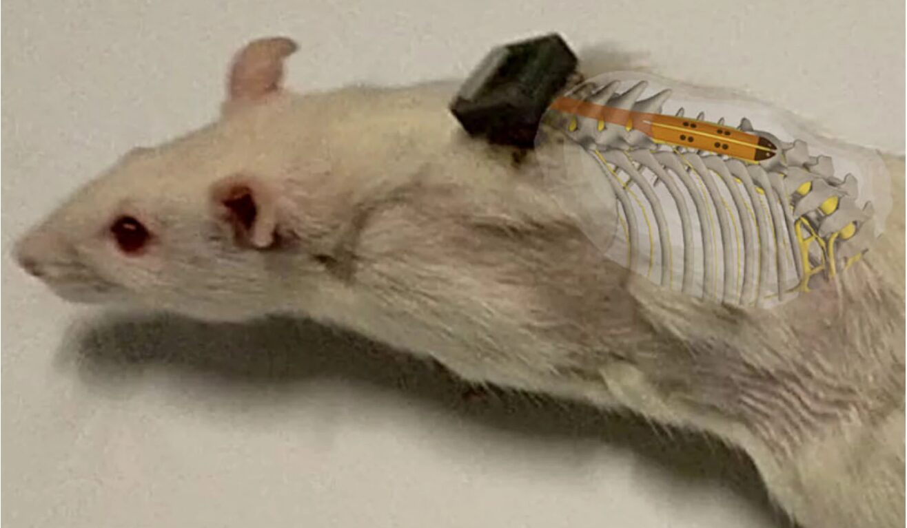 Voltar a andar com implantes